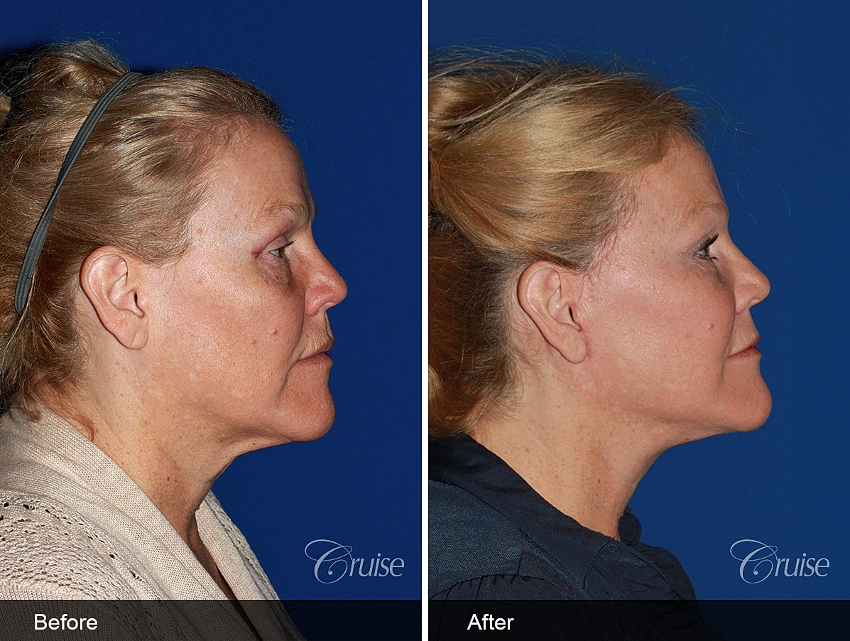 Face Lift Before & After