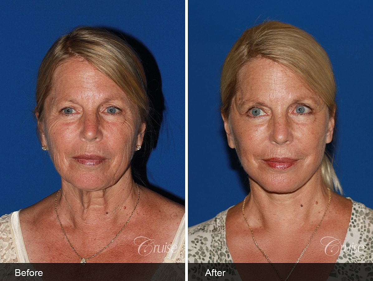 Face Lift Before & After