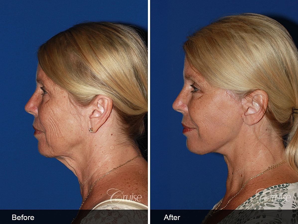 Face Lift Before & After