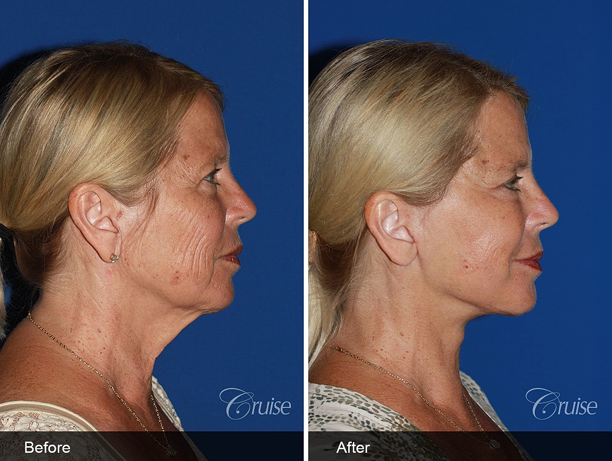 Face Lift Before & After