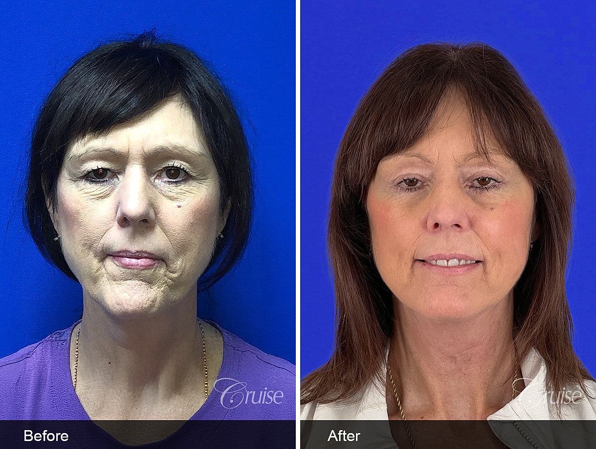 Face Lift Before & After