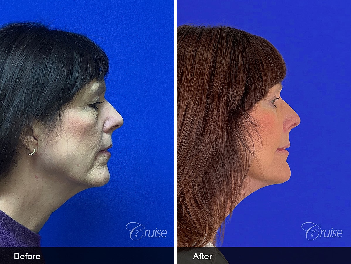 Face Lift Before & After