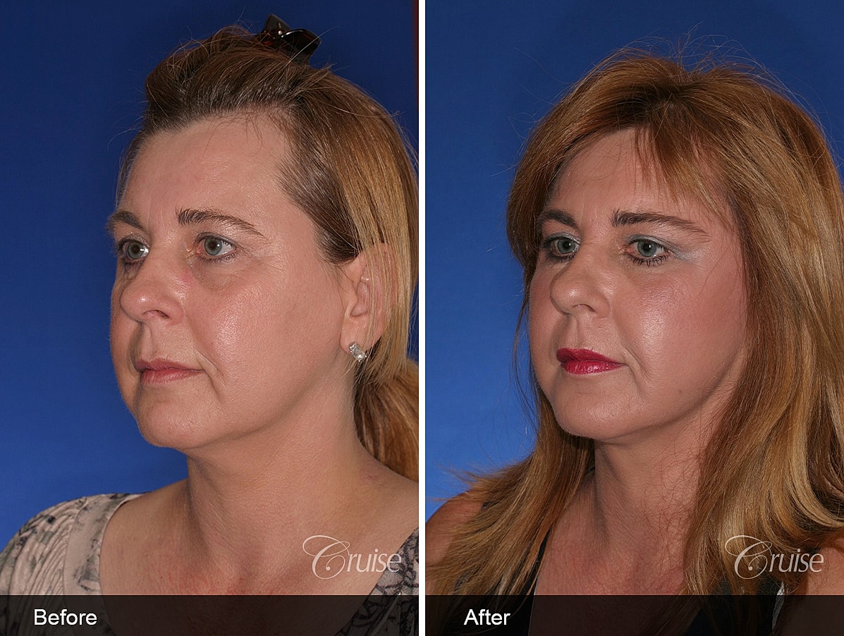 Face Lift Before & After