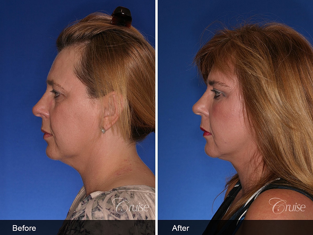 Face Lift Before & After