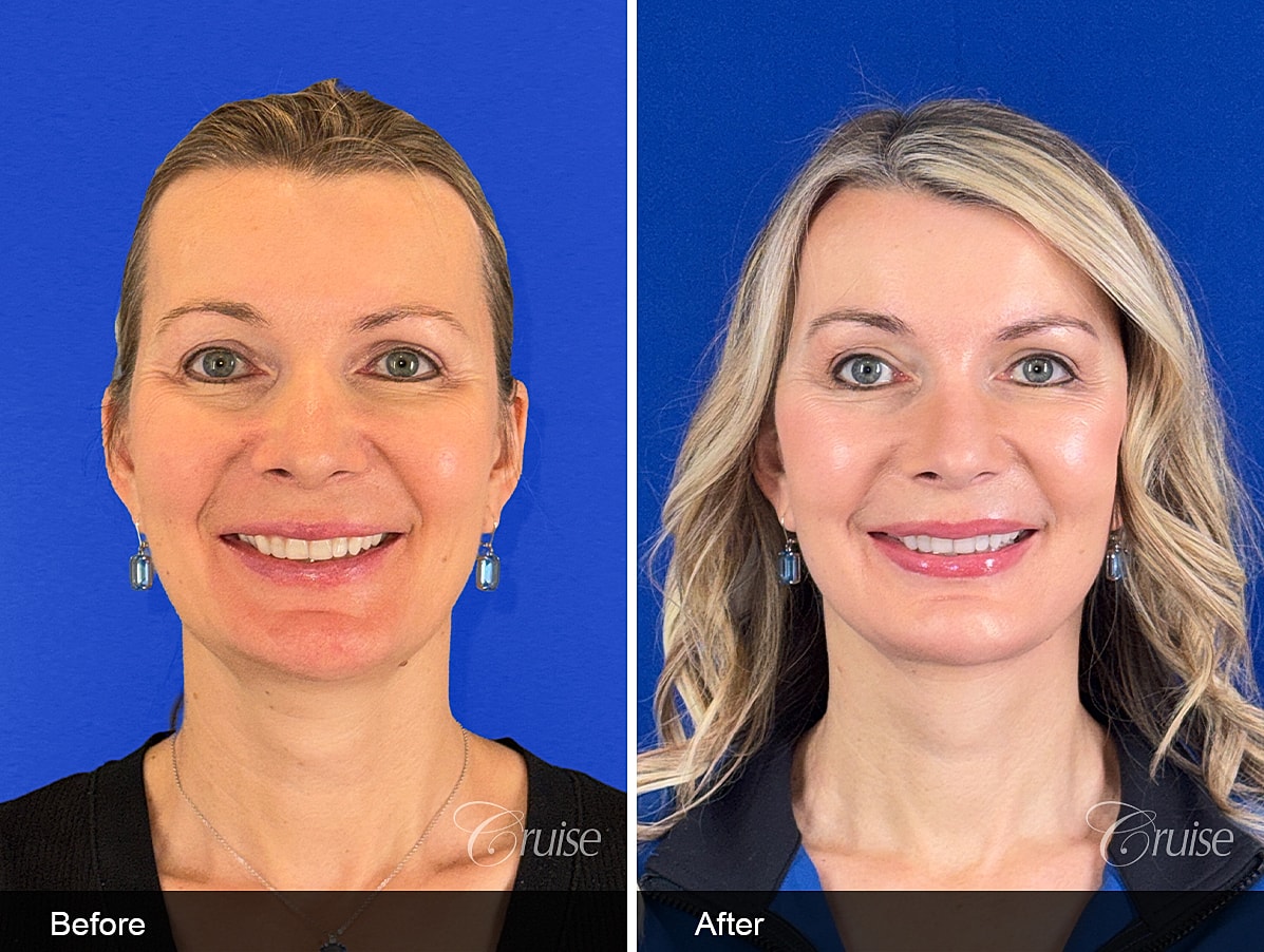 Face Lift Before & After