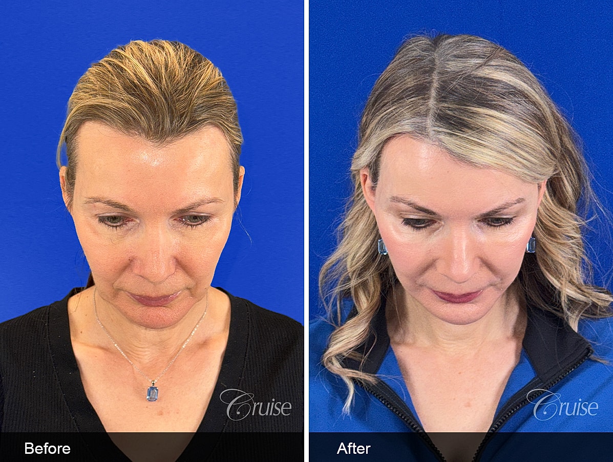 Face Lift Before & After