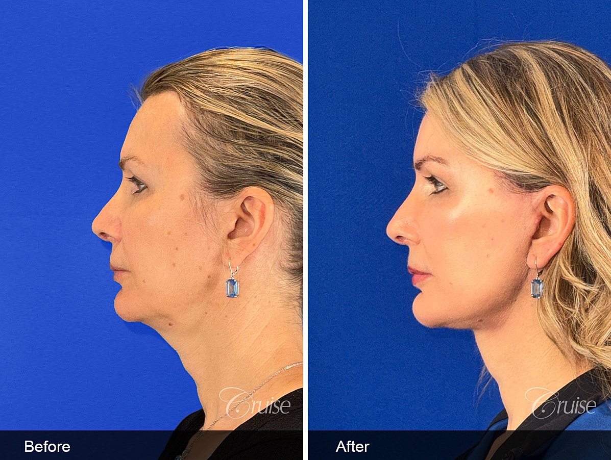 Face Lift Before & After