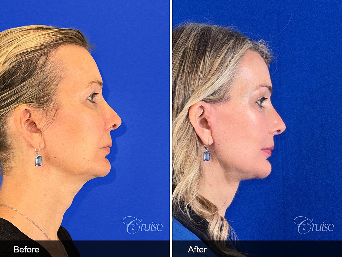 Face Lift Before & After