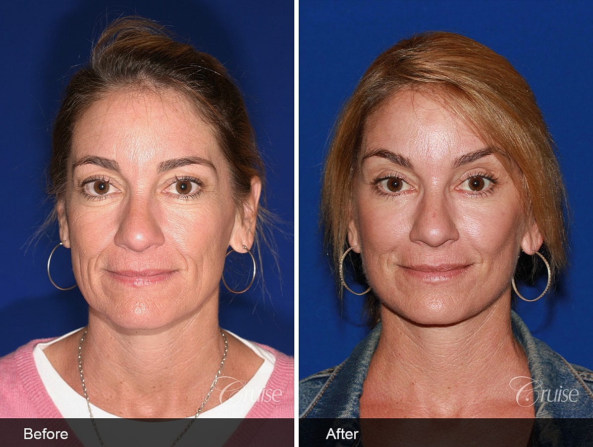 Face Lift Before & After