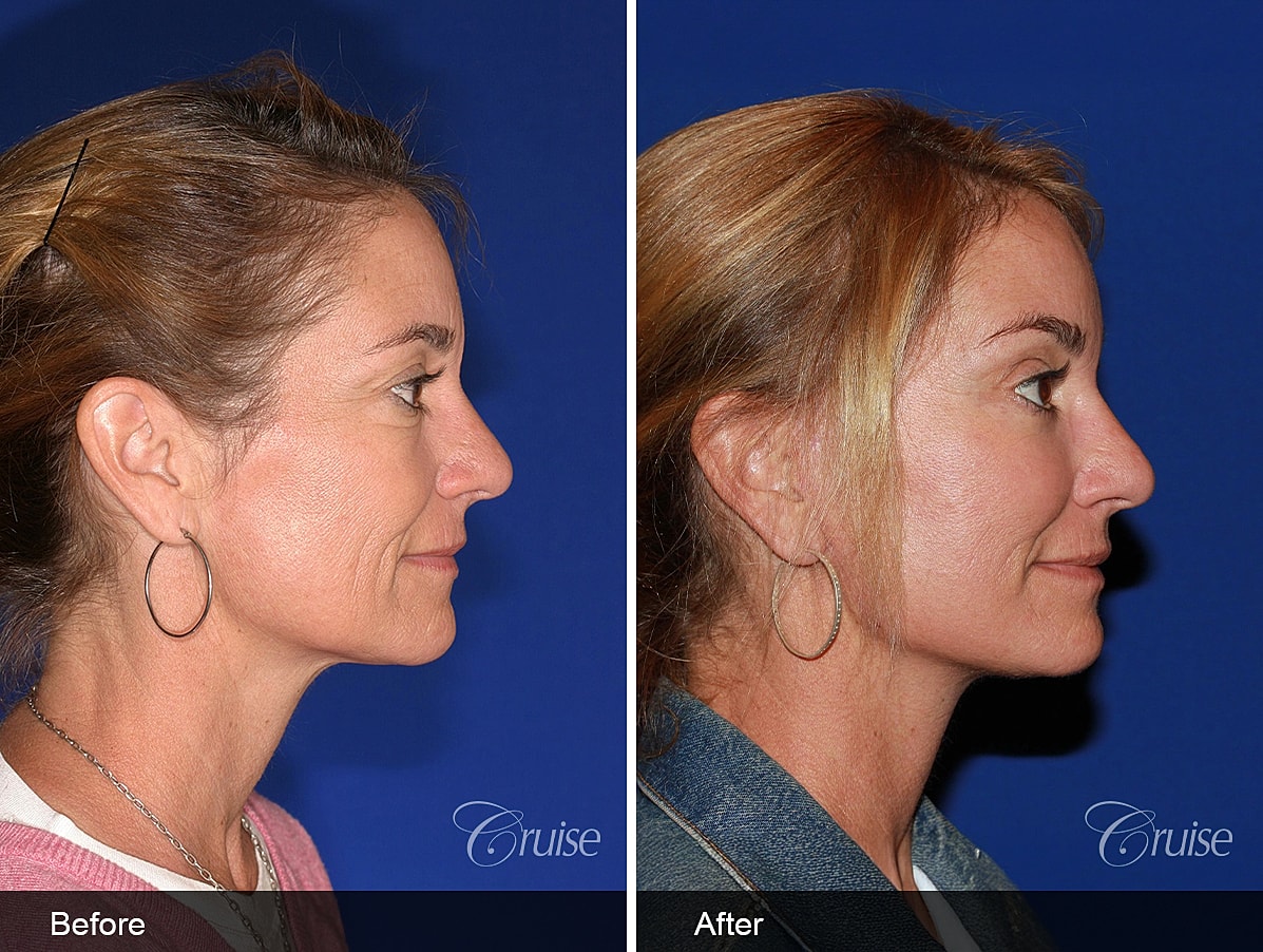 Face Lift Before & After