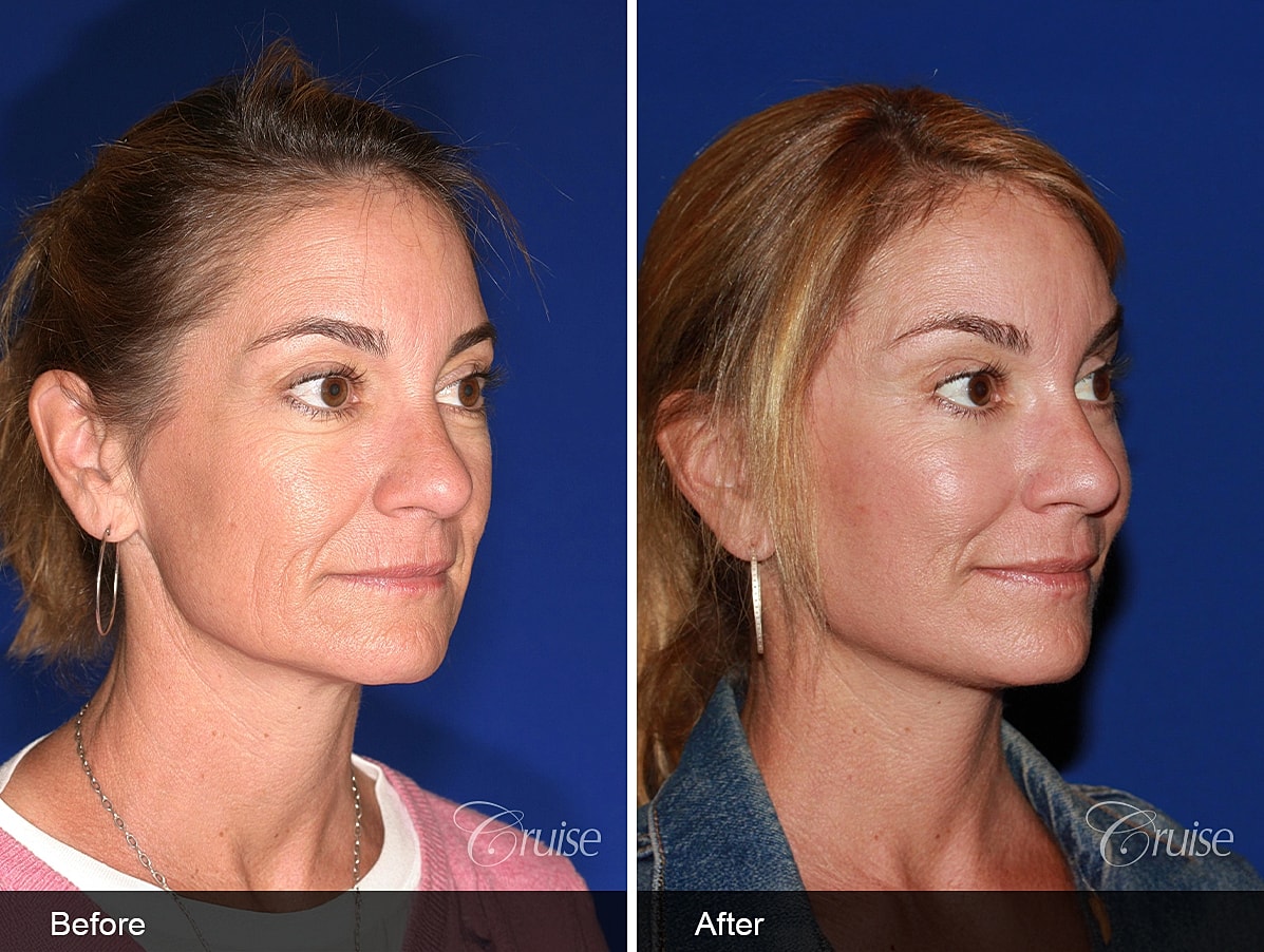 Face Lift Before & After