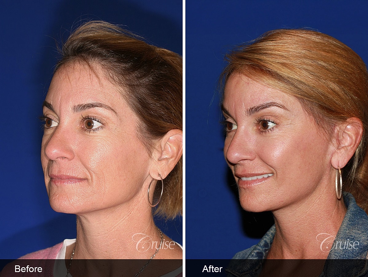 Face Lift Before & After