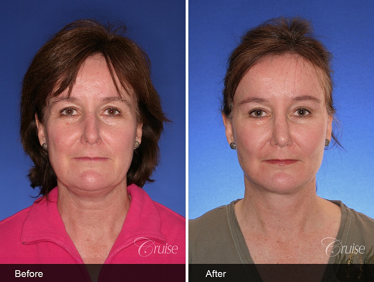 Face Lift Before & After