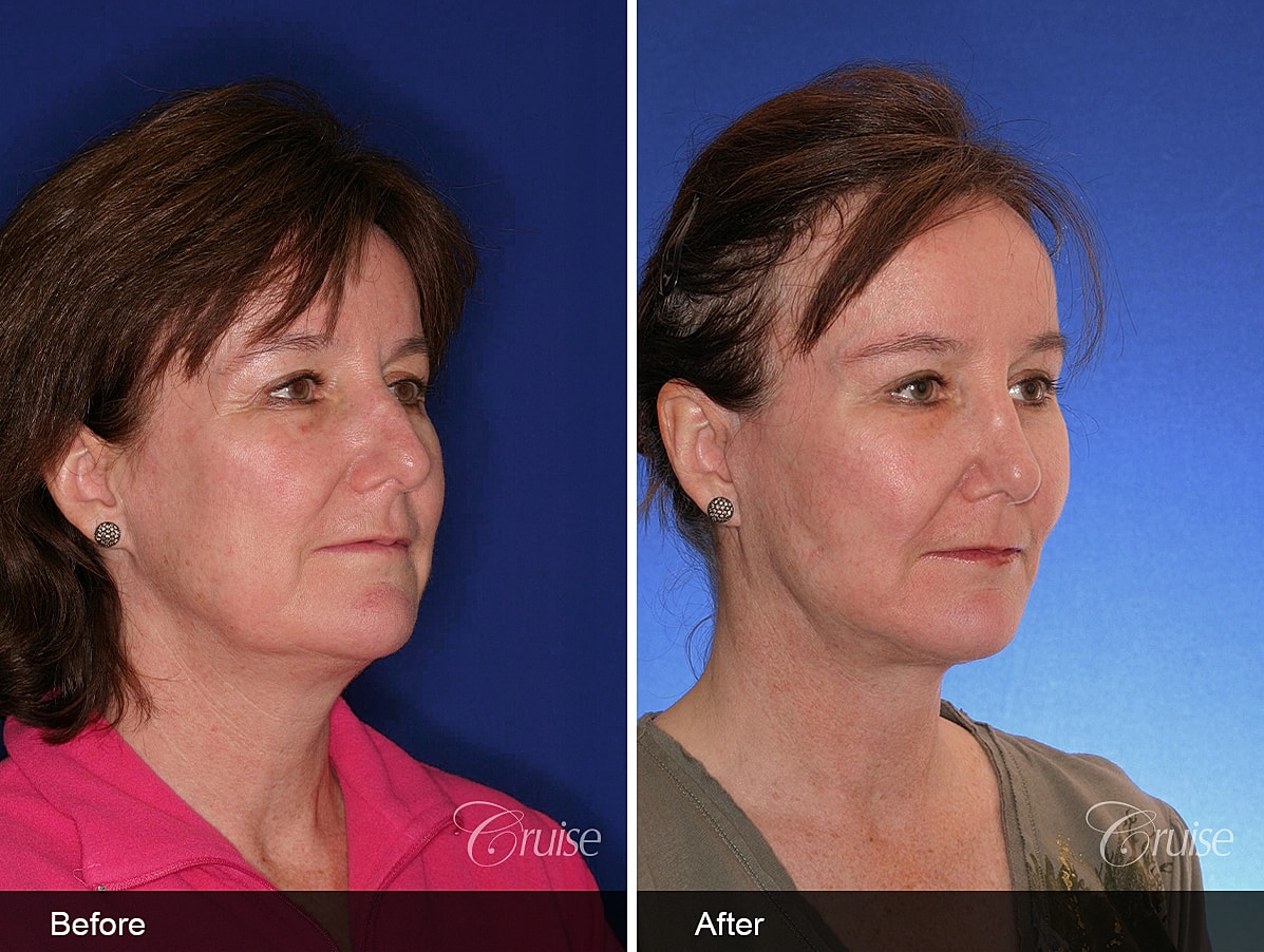 Face Lift Before & After