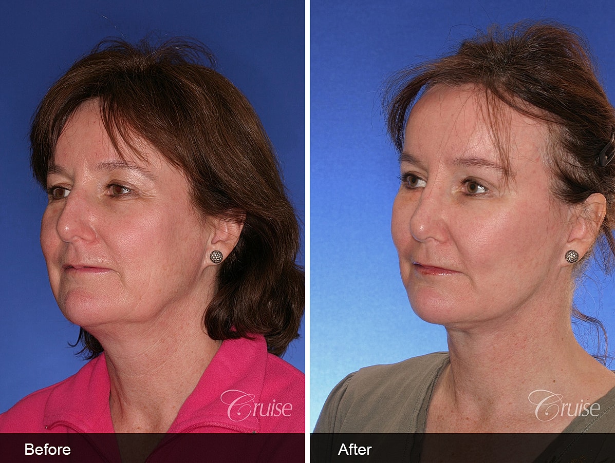 Face Lift Before & After