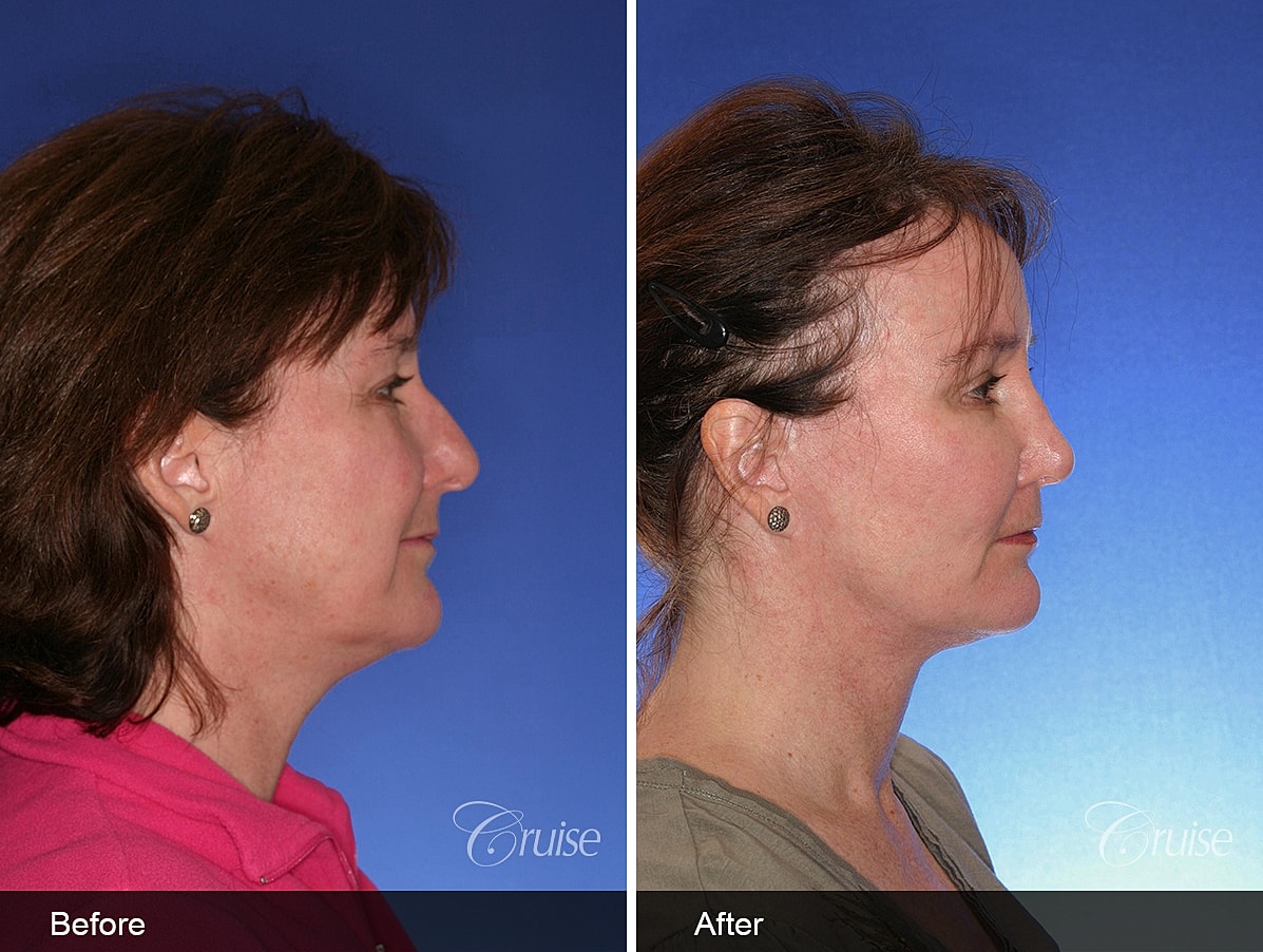 Face Lift Before & After