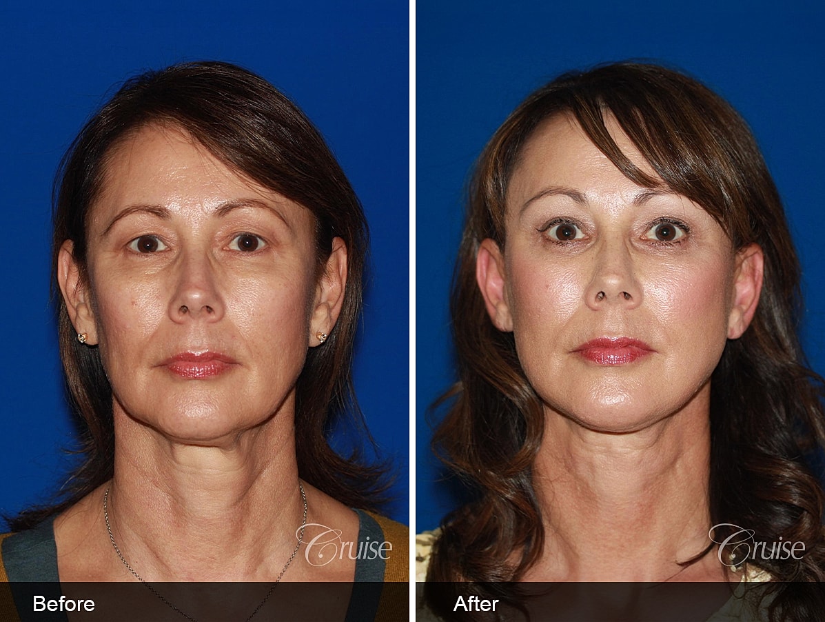 Face Lift Before & After