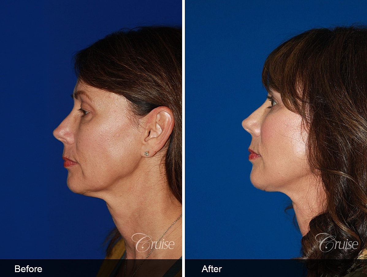 Face Lift Before & After