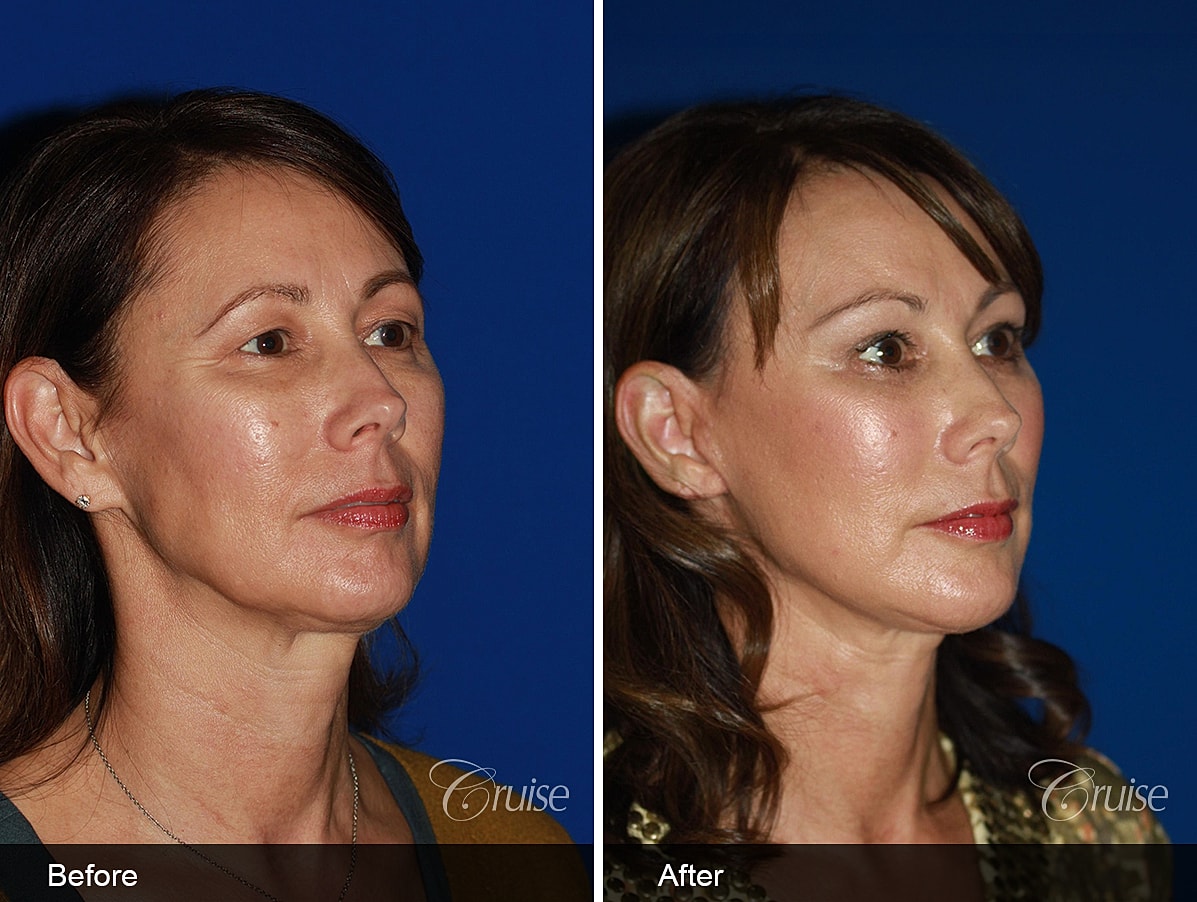 Face Lift Before & After