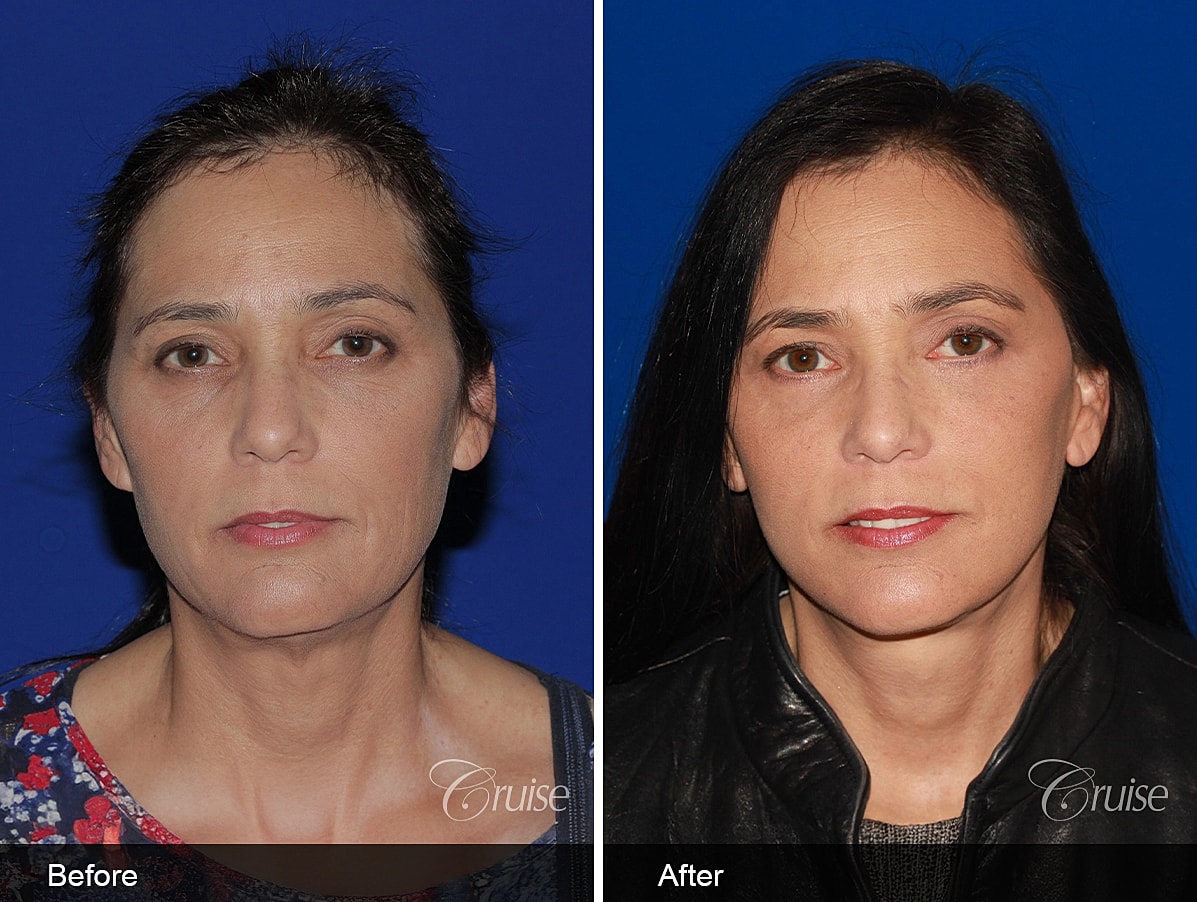 Face Lift Before & After