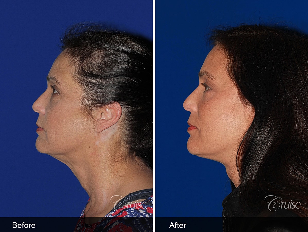 Face Lift Before & After