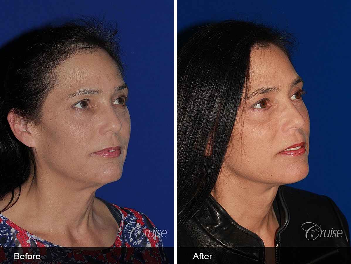 Face Lift Before & After