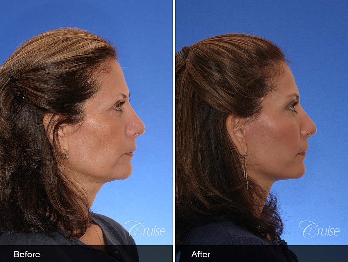 Face Lift Before & After