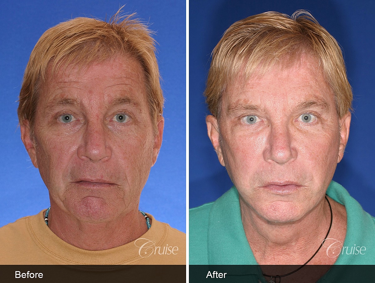 Face Lift Before & After