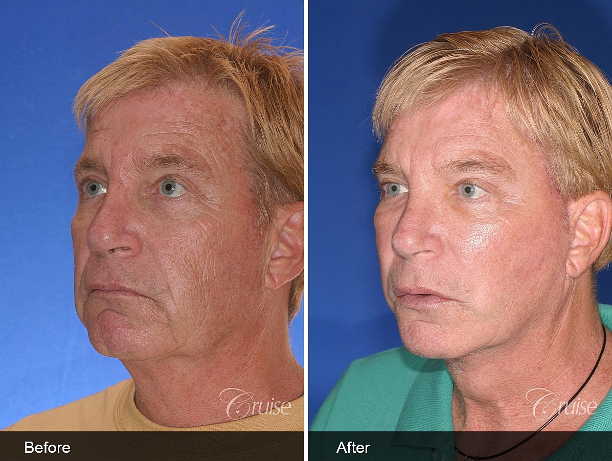Face Lift Before & After
