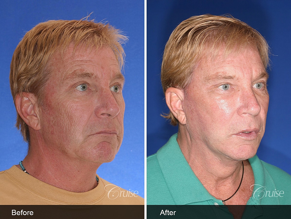 Face Lift Before & After