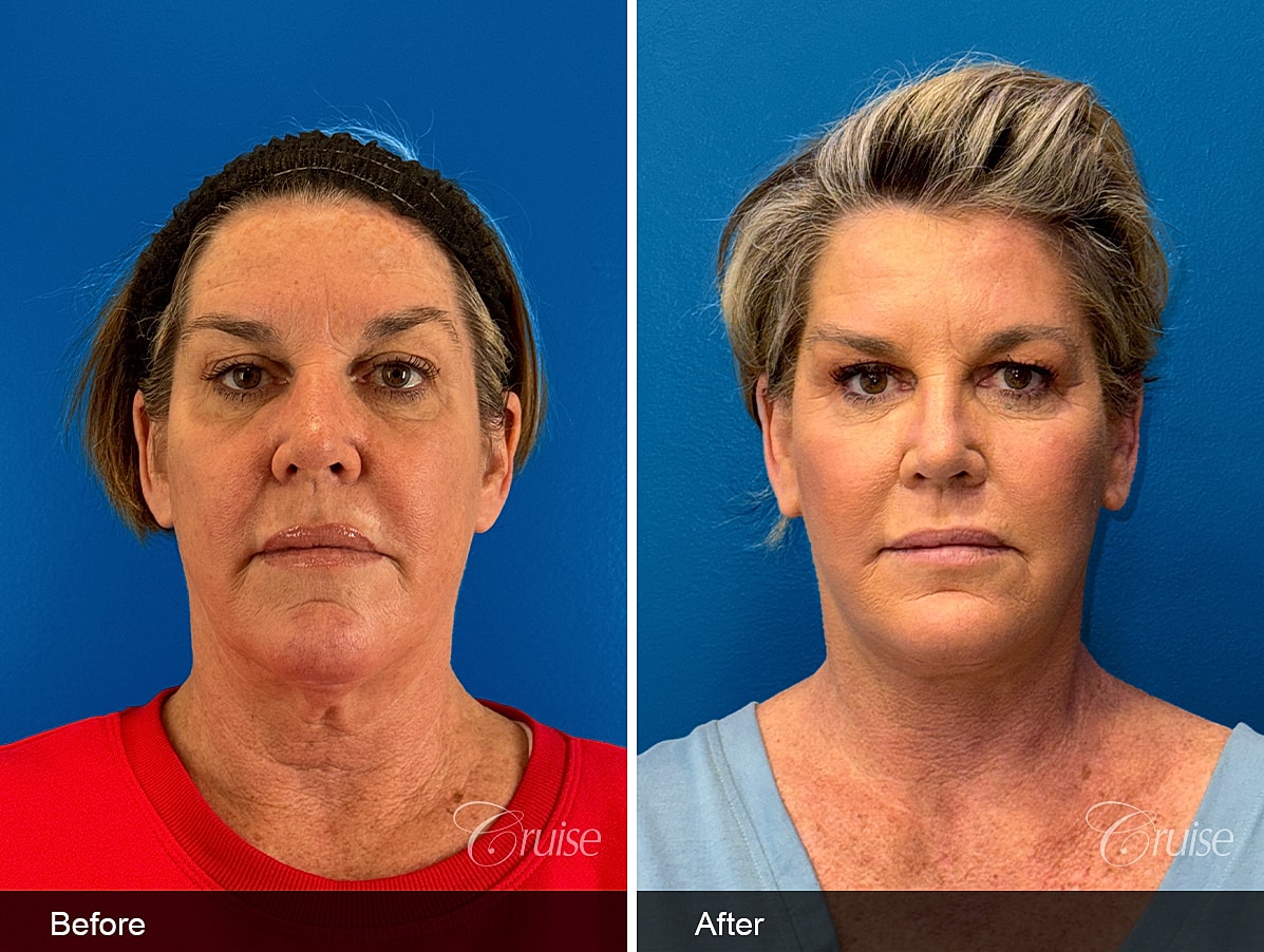 Face Lift Before & After