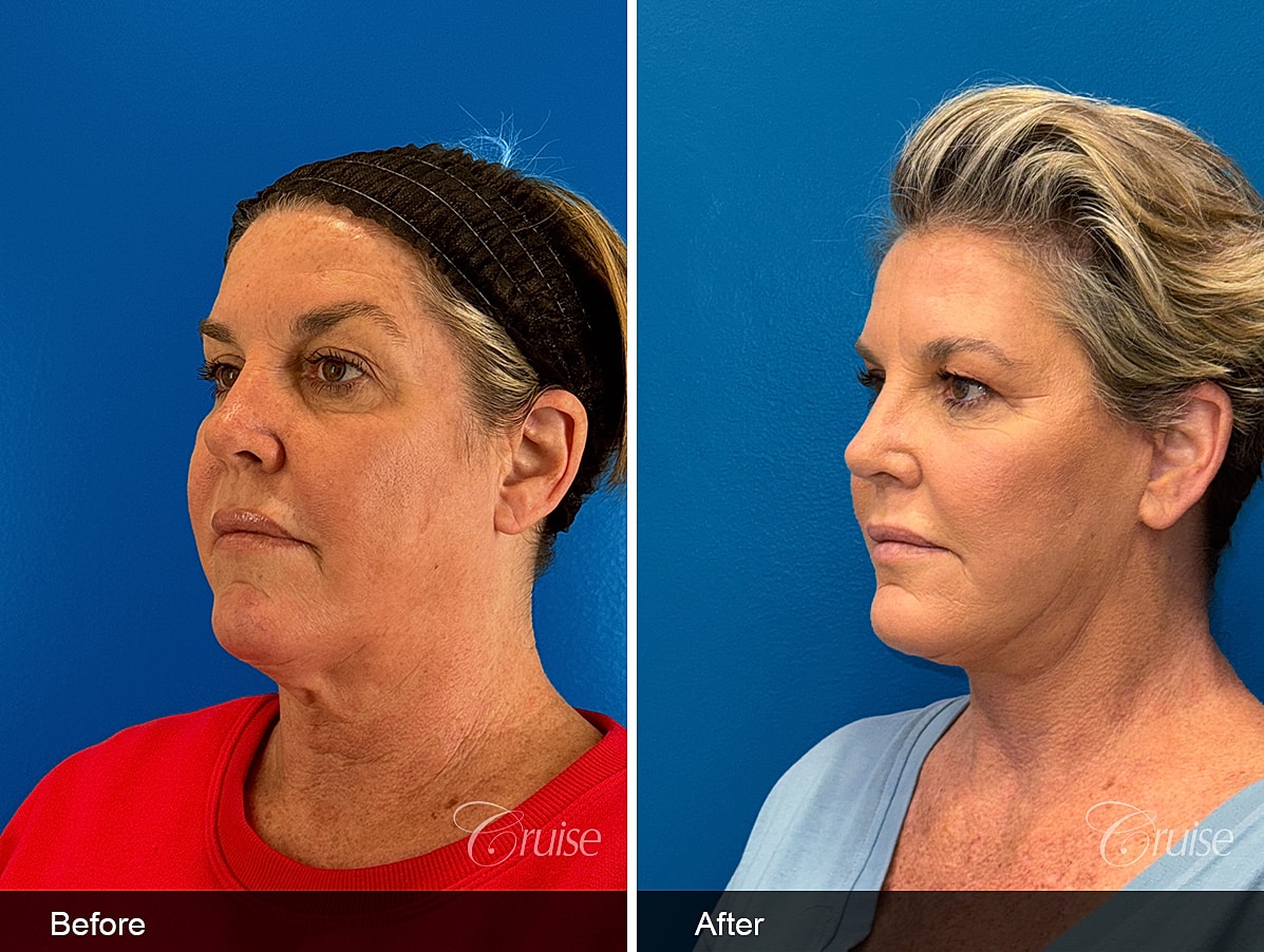 Face Lift Before & After