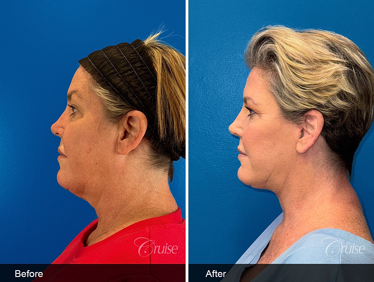 Face Lift Before & After