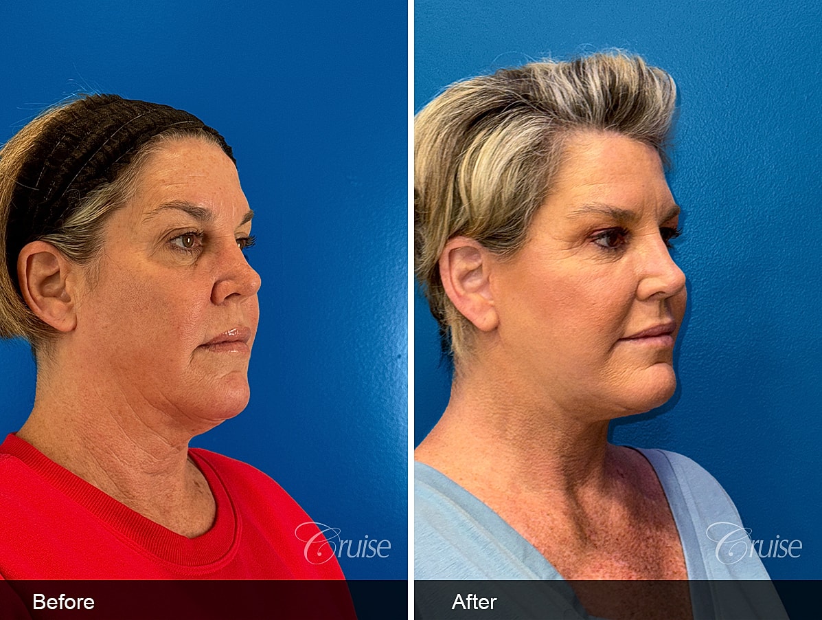 Face Lift Before & After