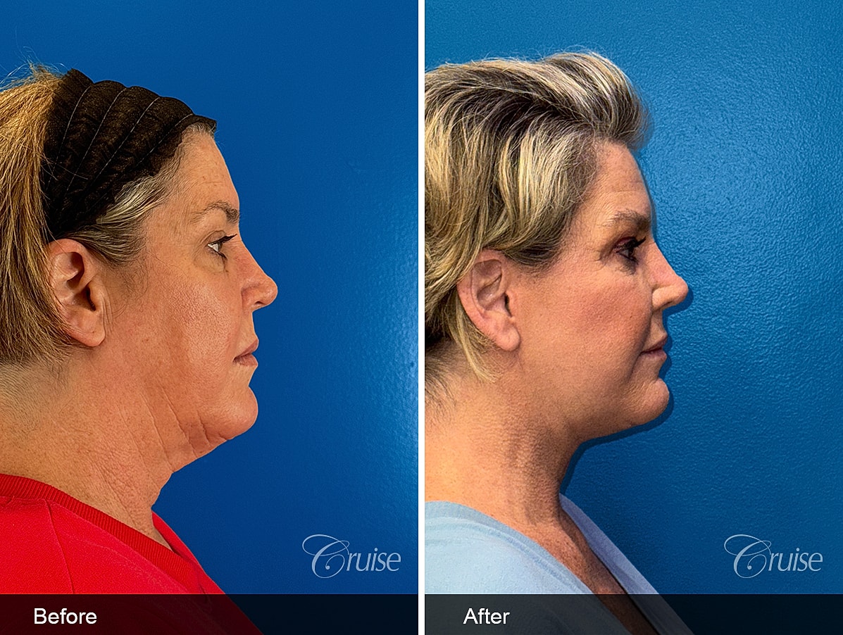 Face Lift Before & After