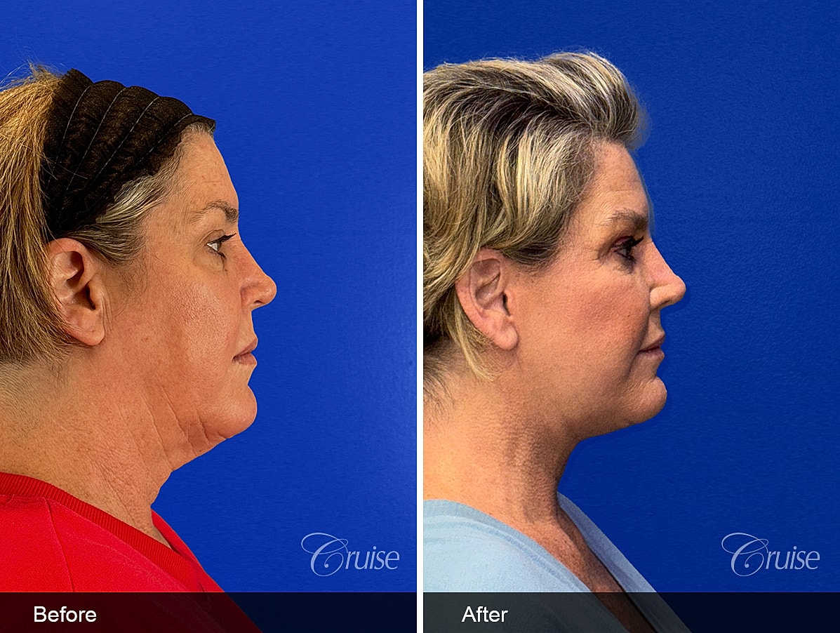 Face Lift Before & After