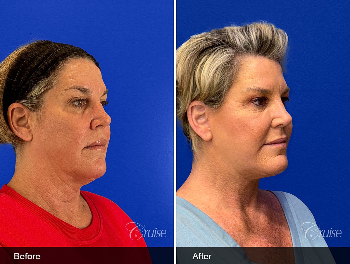 Face Lift Before & After