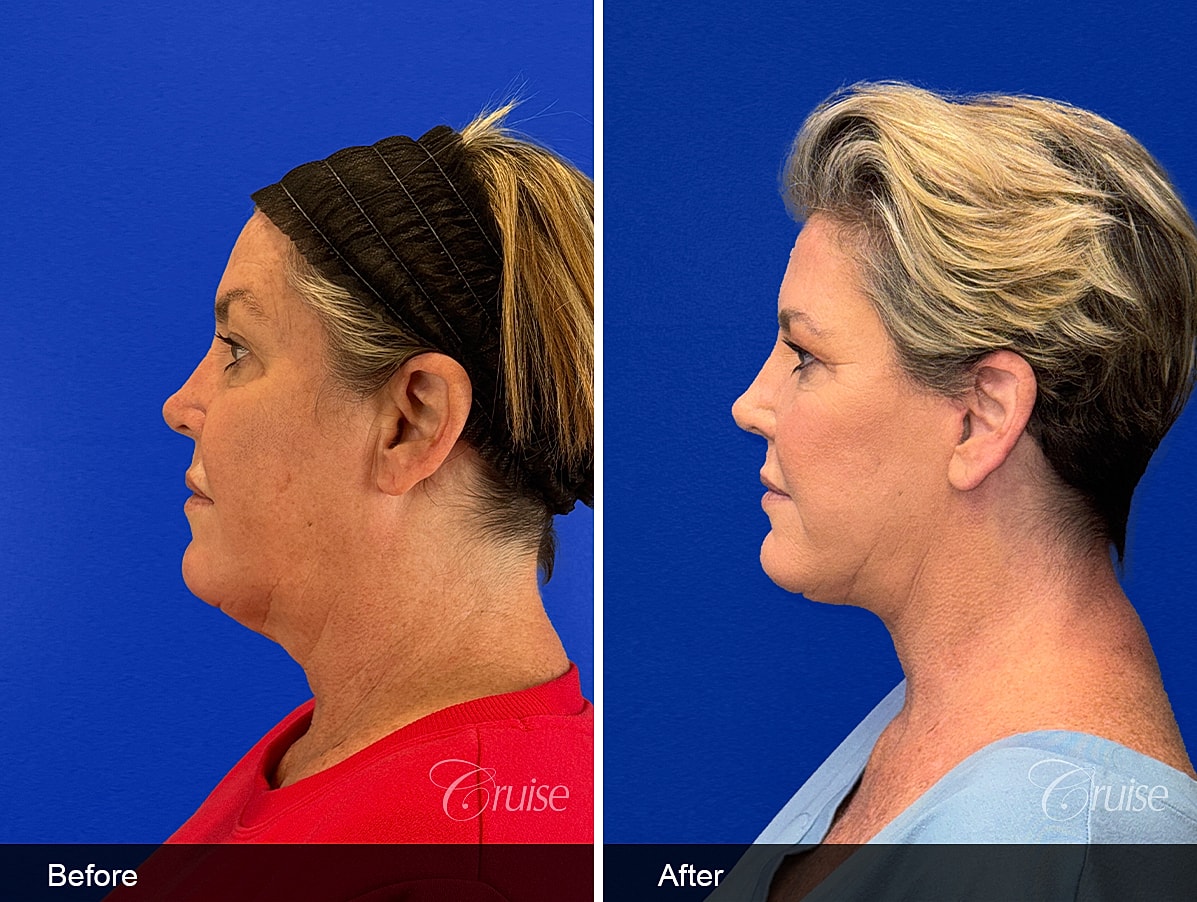 Face Lift Before & After