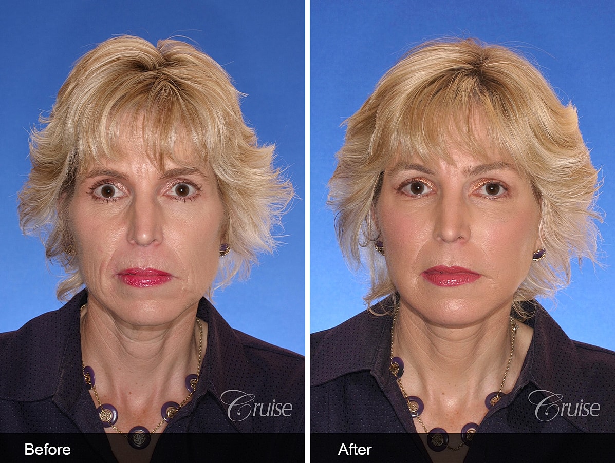 Face Lift Before & After