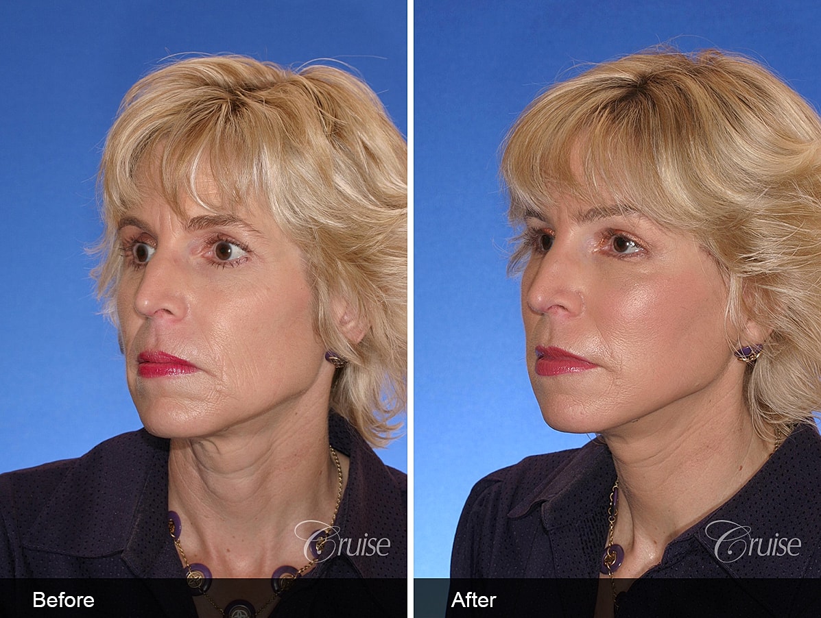 Face Lift Before & After