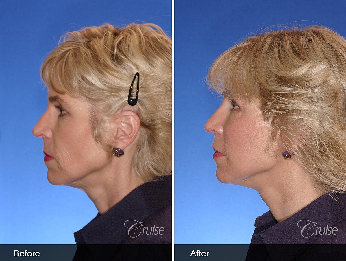 Face Lift Before & After