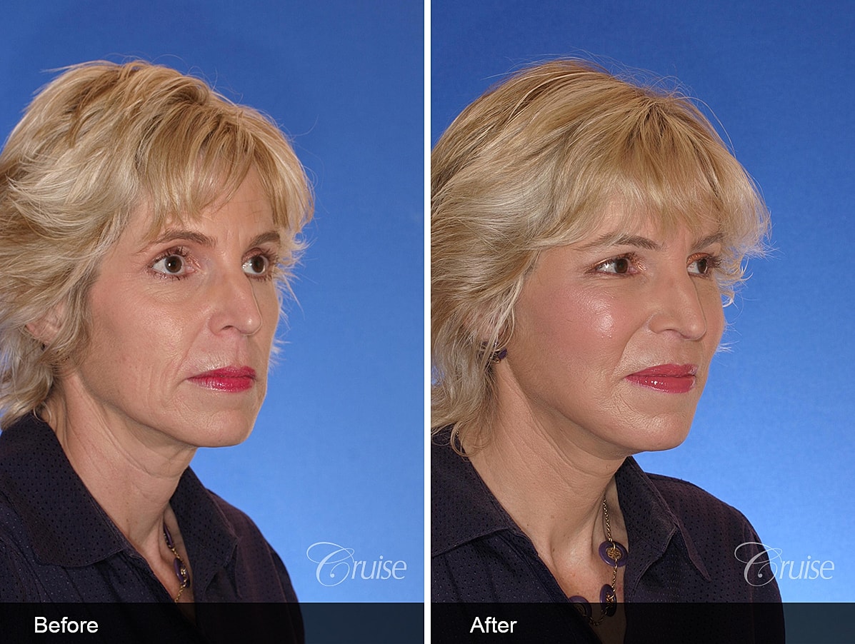 Face Lift Before & After