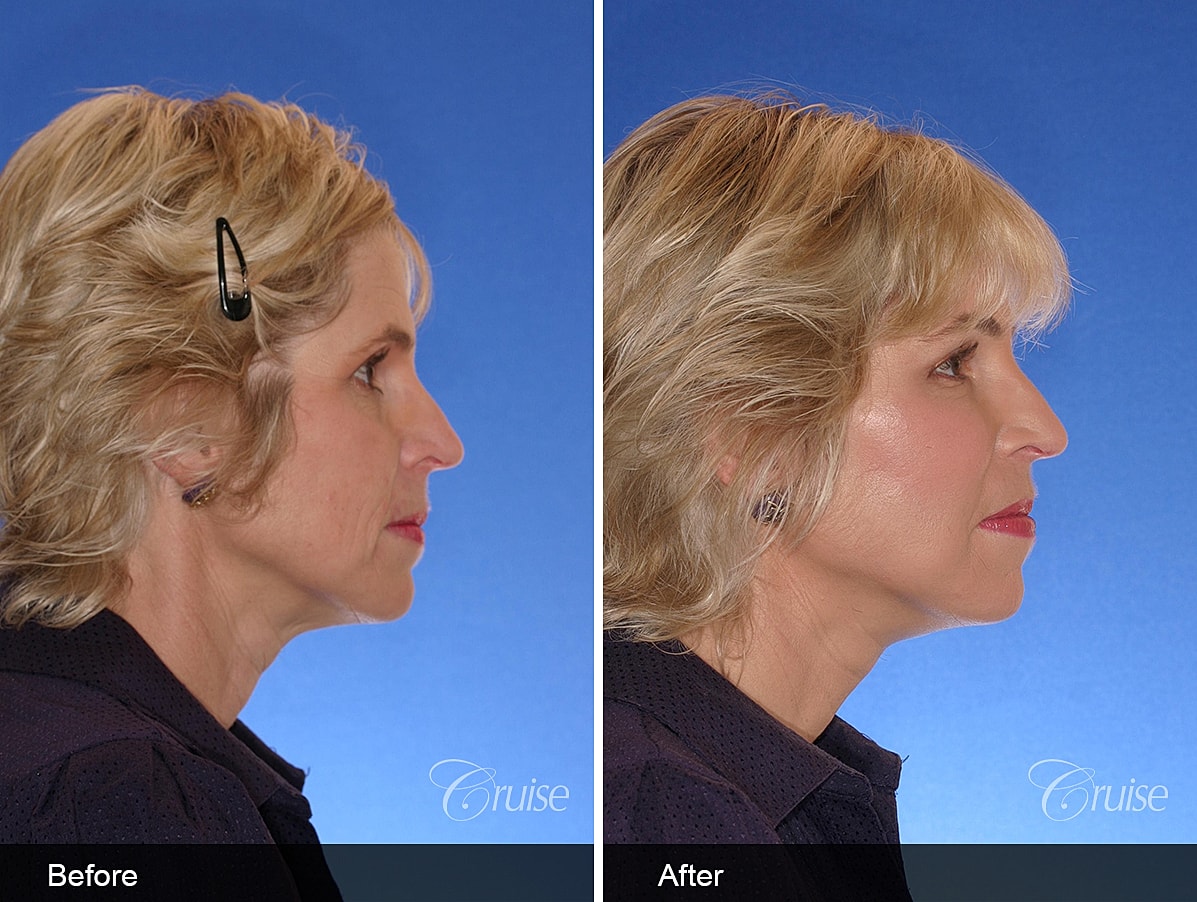 Face Lift Before & After