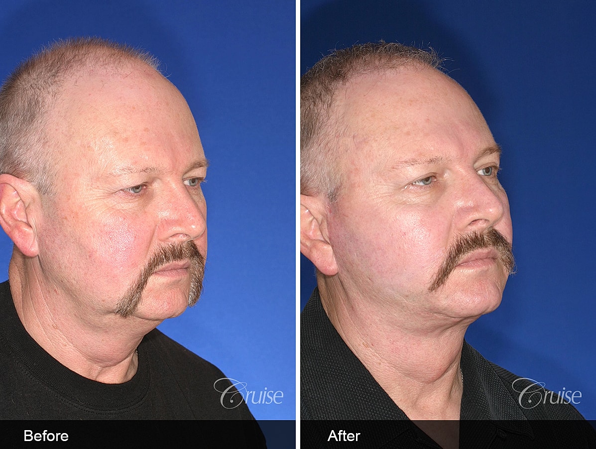 Face Lift Before & After