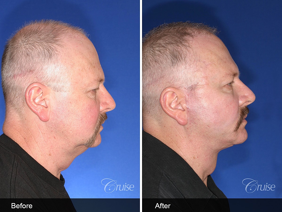 Face Lift Before & After