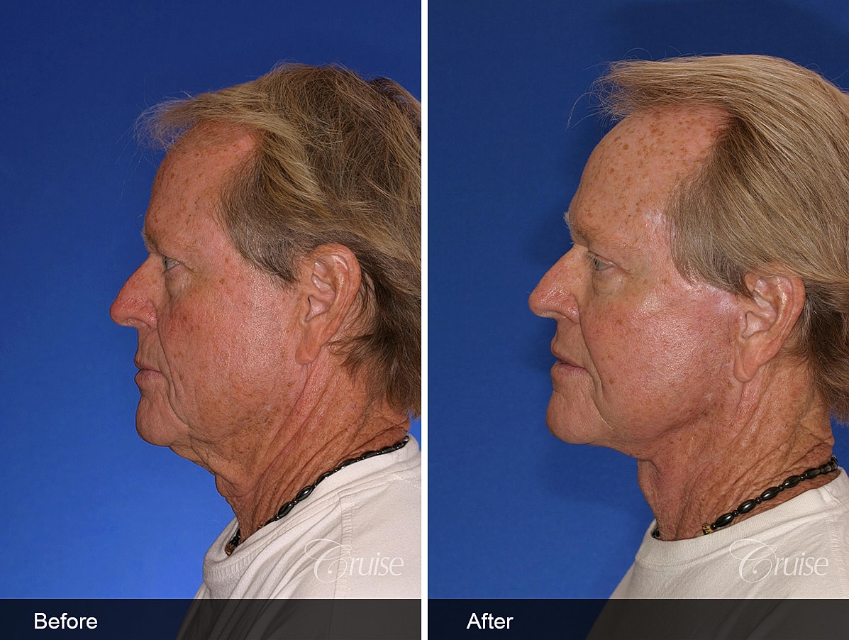 Face Lift Before & After