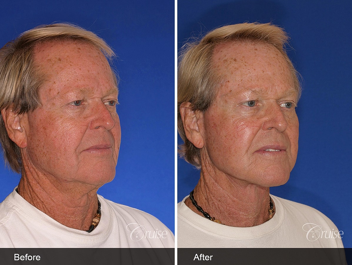 Face Lift Before & After