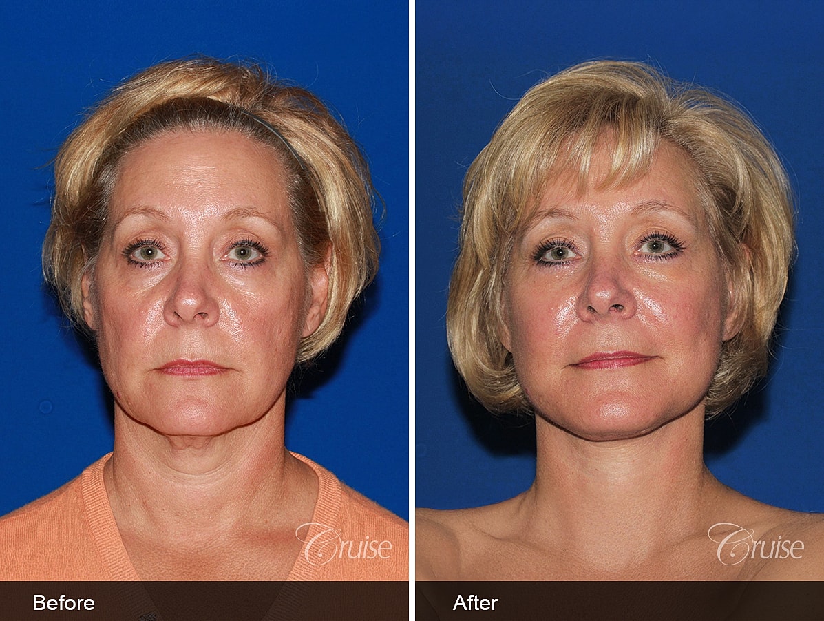 Face Lift Before & After