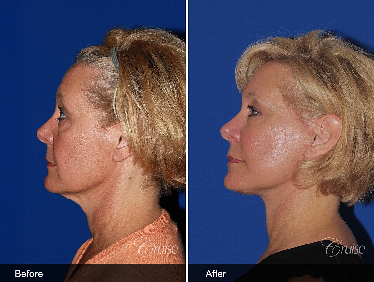 Face Lift Before & After