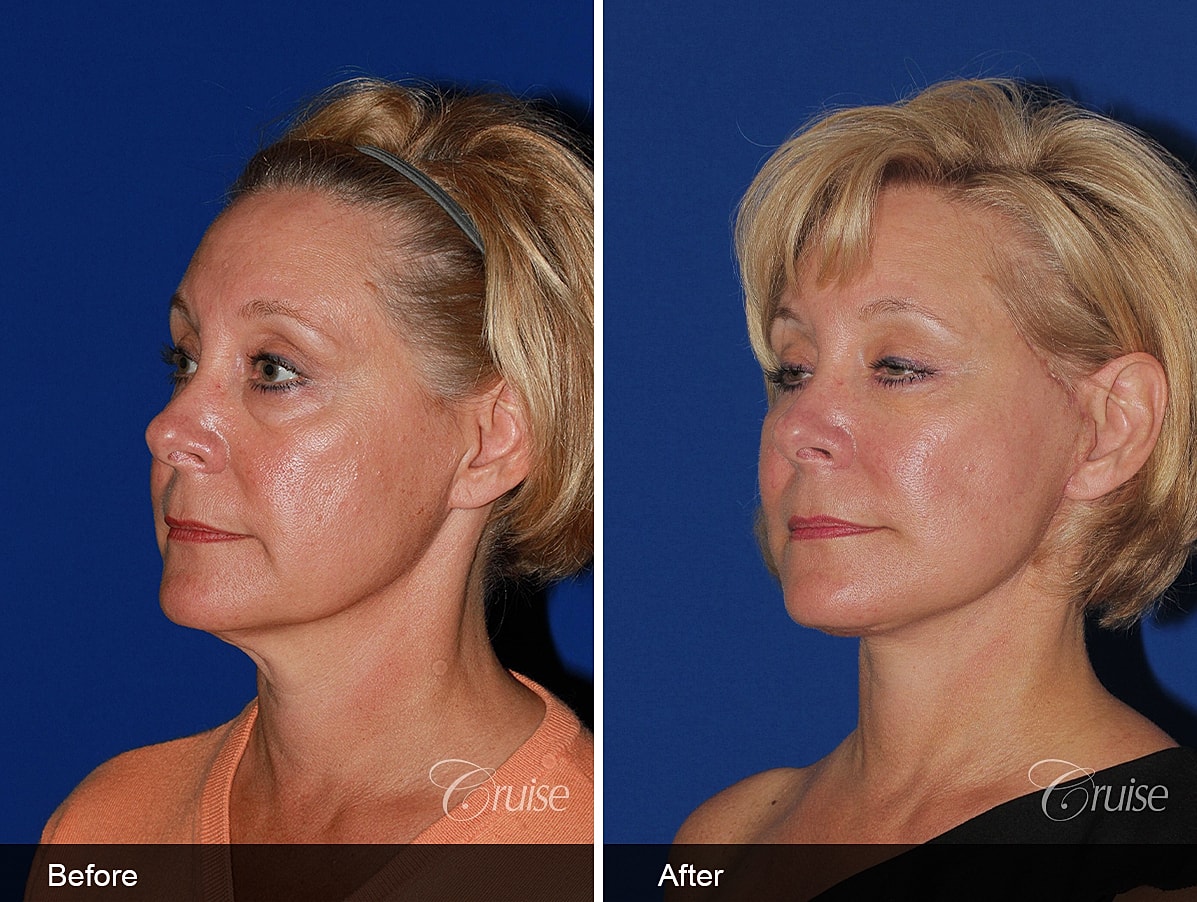 Face Lift Before & After